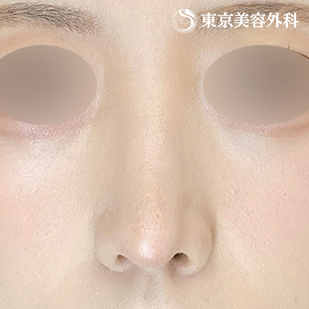 鼻尖形成（切開法+軟骨移植）・鼻中隔延長 （鼻軟骨移植法）・鼻骨骨切り・貴族手術（肋軟骨）の症例写真 術後6ヵ月【6枚目】
