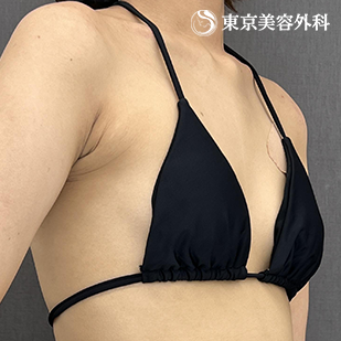 シリコンバッグ豊胸の症例写真 before【1枚目】