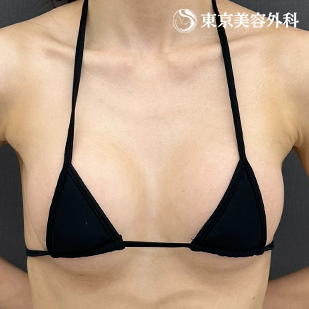 シリコンバッグ豊胸の症例写真 術後4ヵ月【4枚目】