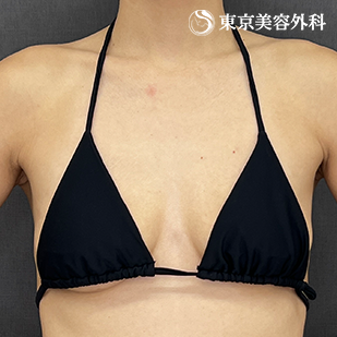 シリコンバッグ豊胸の症例写真 before【3枚目】