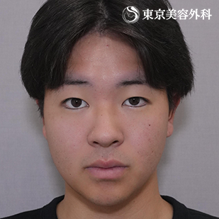 オープンアイズ（切らない眼瞼下垂）｜ホストコール・龍征さんの症例写真 before【1枚目】