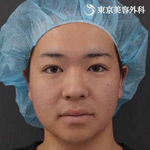 オープンアイズ（切らない眼瞼下垂）｜ホストコール・龍征さんの症例写真 術直後【2枚目】