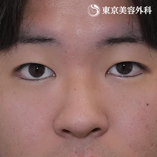 オープンアイズ（切らない眼瞼下垂）｜ホストコール・龍征さんの症例写真 before【3枚目】