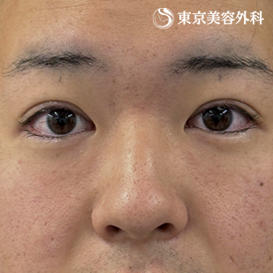 オープンアイズ（切らない眼瞼下垂）｜ホストコール・龍征さんの症例写真 術直後【4枚目】