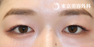 切開二重(全切開)・目の上のたるみ取り+脂肪取り・ 目頭切開（プレミアム）の症例写真 before【1枚目】