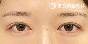 切開二重(全切開)・目の上のたるみ取り+脂肪取り・ 目頭切開（プレミアム）の症例写真 術後3ヵ月【2枚目】