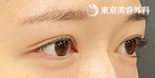 切開二重(全切開)・目の上のたるみ取り+脂肪取り・ 目頭切開（プレミアム）の症例写真 【4枚目】