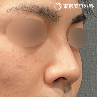 鼻中隔延長（東美オリジナル鼻軟骨移植法） ・鼻尖形成（切開法+軟骨移植）の症例写真 before【1枚目】
