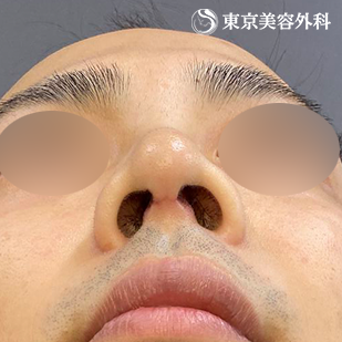 鼻中隔延長（東美オリジナル鼻軟骨移植法） ・鼻尖形成（切開法+軟骨移植）の症例写真 術後1ヵ月【6枚目】