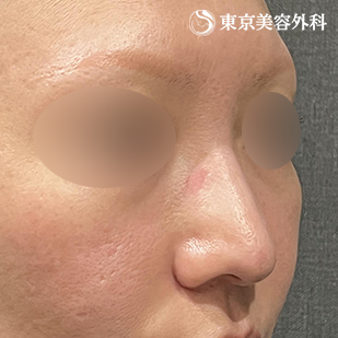 鼻尖形成（切開法+軟骨移植） ・鼻中隔延長（東美オリジナル鼻軟骨移植法）の症例写真 before【1枚目】