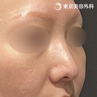 鼻尖形成（切開法+軟骨移植） ・鼻中隔延長（東美オリジナル鼻軟骨移植法）の症例写真 術後5ヵ月【2枚目】