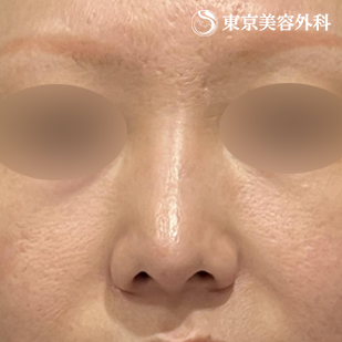 鼻尖形成（切開法+軟骨移植） ・鼻中隔延長（東美オリジナル鼻軟骨移植法）の症例写真 術後5ヵ月【4枚目】