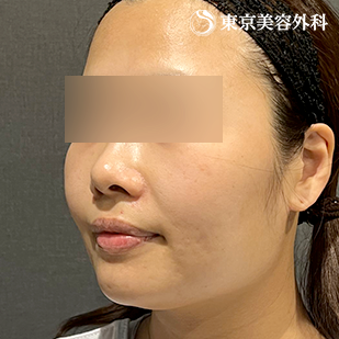エラ骨切り（下顎角形成・外板切除）・オプション（脂肪吸引）の症例写真 before【3枚目】
