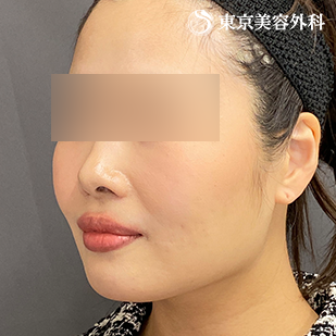 エラ骨切り（下顎角形成・外板切除）・オプション（脂肪吸引）の症例写真 術後6ヵ月【4枚目】