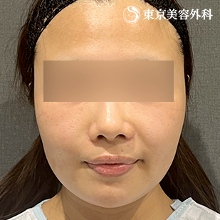 エラ骨切り（下顎角形成・外板切除）・オプション（脂肪吸引）の症例写真 before【1枚目】