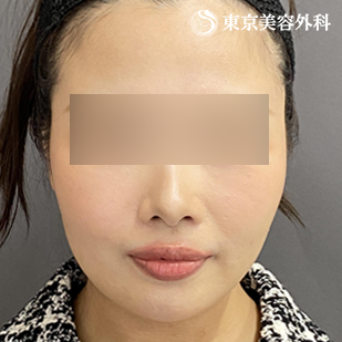エラ骨切り（下顎角形成・外板切除）・オプション（脂肪吸引）の症例写真 術後6ヵ月【2枚目】