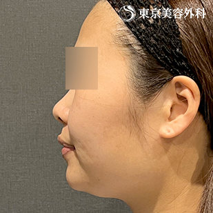 エラ骨切り（下顎角形成・外板切除）・オプション（脂肪吸引）の症例写真 before【5枚目】