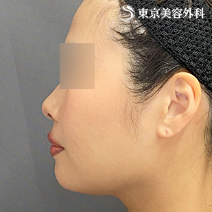 エラ骨切り（下顎角形成・外板切除）・オプション（脂肪吸引）の症例写真 術後6ヵ月【6枚目】