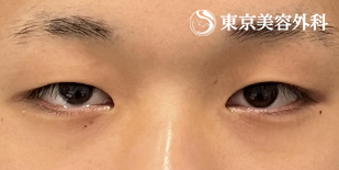 埋没二重（3点留め）・ まぶたの脂肪取り（上まぶた切開）の症例写真 before【1枚目】