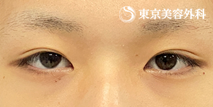 埋没二重（3点留め）・ まぶたの脂肪取り（上まぶた切開）の症例写真 術後9ヵ月【2枚目】