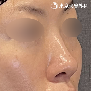 鼻尖形成（切開法+軟骨移植）・鼻中隔延長（東美オリジナル鼻軟骨移植法） ・隆鼻術（オーダーメードプロテーゼ）の症例写真 before【1枚目】