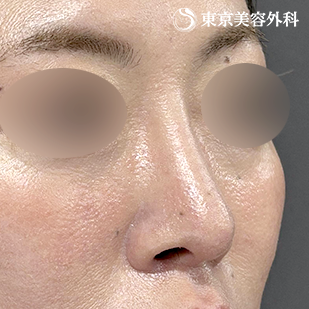 鼻尖形成（切開法+軟骨移植）・鼻中隔延長（東美オリジナル鼻軟骨移植法） ・隆鼻術（オーダーメードプロテーゼ）の症例写真 術後6ヵ月【2枚目】