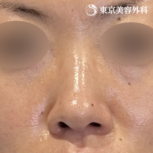鼻尖形成（切開法+軟骨移植）・鼻中隔延長（東美オリジナル鼻軟骨移植法） ・隆鼻術（オーダーメードプロテーゼ）の症例写真 before【3枚目】