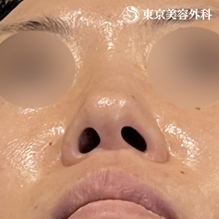 鼻尖形成（切開法+軟骨移植）・鼻中隔延長（東美オリジナル鼻軟骨移植法） ・隆鼻術（オーダーメードプロテーゼ）の症例写真 before【5枚目】