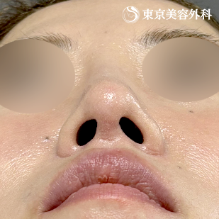 鼻尖形成（切開法+軟骨移植）・鼻中隔延長（東美オリジナル鼻軟骨移植法） ・隆鼻術（オーダーメードプロテーゼ）の症例写真 術後6ヵ月【6枚目】