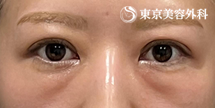 下まぶたの脂肪取り（経結膜アプローチ法）の症例写真 before【1枚目】