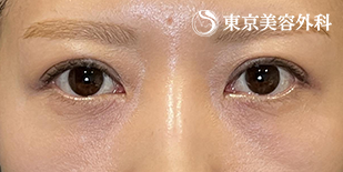 下まぶたの脂肪取り（経結膜アプローチ法）の症例写真 術後1ヵ月【2枚目】