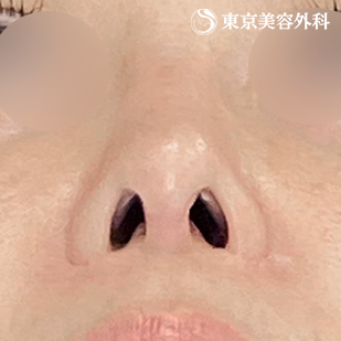 他院プロテーゼ抜去・鼻尖形成（切開法+軟骨移植）・隆鼻術（オーダーメードプロテーゼ）の症例写真 術後6ヵ月【8枚目】