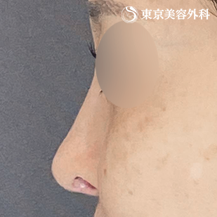 他院プロテーゼ抜去・鼻尖形成（切開法+軟骨移植）・隆鼻術（オーダーメードプロテーゼ）の症例写真 術後6ヵ月【6枚目】