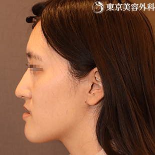 顎矯正手術 オトガイ形成 Ta1466 の症例写真 美容整形は東京美容外科