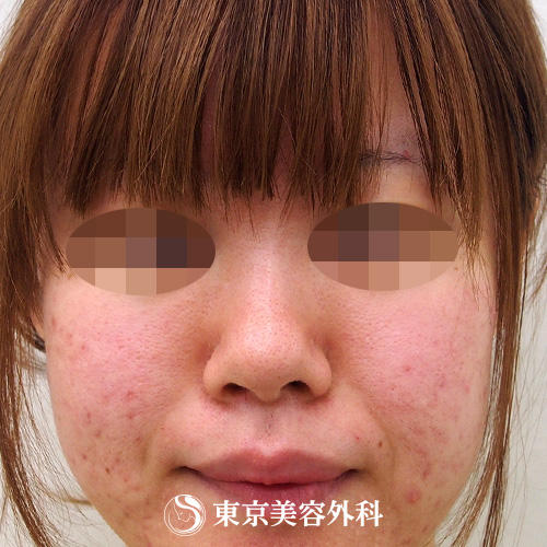 隆鼻術 Ar2341 鼻を高くしスッと通った鼻筋に 美容整形は東京美容外科