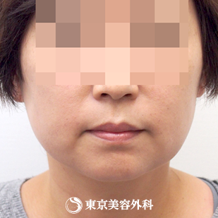 脂肪吸引 ホホ フェイスライン アゴ Ar5431 痩せにくいフェイスラインがスッキリ 美容整形は東京美容外科