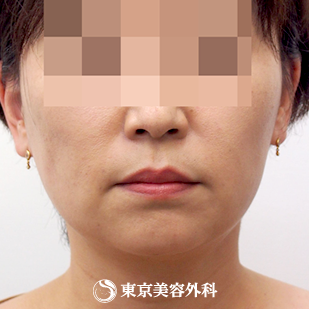脂肪吸引 ホホ フェイスライン アゴ Ar5431 痩せにくいフェイスラインがスッキリ 美容整形は東京美容外科