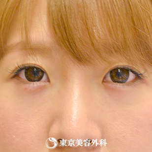 涙袋ヒアルロン酸 Gz6571 自然な涙袋で可愛らしさup 美容整形は東京美容外科 涙袋ヒアルロン酸 Gz6571 自然な涙袋で可愛らしさup 美容整形は東京美容外科