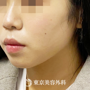 エラボトックス コアトックス 100単位 糸リフト3本ずつ Ak6634 の症例写真 美容整形は東京美容外科 エラボトックス コアトックス 100単位 糸リフト3本ずつ Ak6634 の症例写真 美容整形は東京美容外科