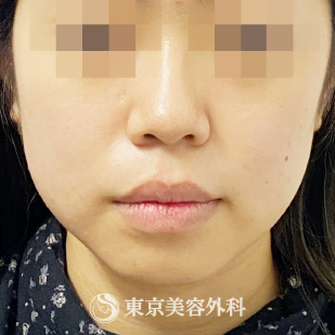 エラボトックス コアトックス 100単位 オルチャンリフト3本ずつ Ak6634 美容整形は東京美容外科 エラボトックス コアトックス 100単位 オルチャンリフト3本ずつ Ak6634 美容整形は東京美容外科