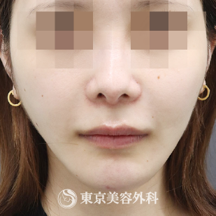 顎矯正手術 親知らず抜歯3本 Ta3229 美容整形は東京美容外科