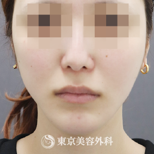 顎矯正手術 親知らず抜歯3本 Ta3229 美容整形は東京美容外科