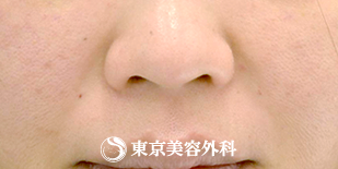 しわ ヒアルロン酸｜gz1025】の症例写真 | 東京美容外科