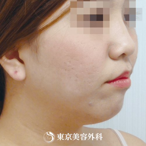 脂肪吸引 フェイスライン Ok6561 痩せにくいフェイスラインも一気にシャープに 美容整形は東京美容外科