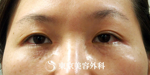 汗管腫 Ou312 メイクでカバーが難し汗管腫をきれいに 美容整形は東京美容外科 汗管腫 Ou312 メイクでカバーが難し汗管腫をきれいに 美容整形は東京美容外科