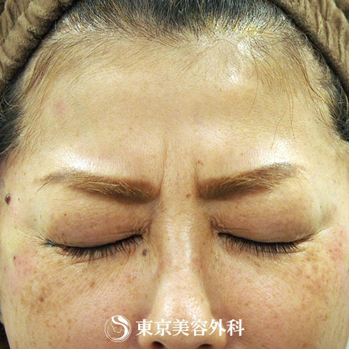 目尻ボトックス Ou707 表情のくせによる頑固なしわに 美容整形は東京美容外科