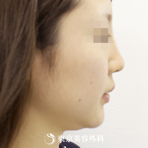 鼻ヒアルロン酸 顎ヒアルロン酸 Si1242 たった5分でバランスのとれた綺麗な横顔に 美容整形は東京美容外科