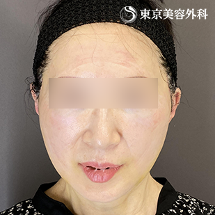 小顔・フェイスライン改善｜フェイスリフト＋ネックリフト症例｜60代