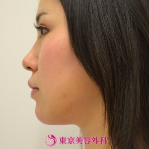 顎ヒアルロン酸 ボトックス Gz ヒアルロン酸で簡単に横顔美人 美容整形は東京美容外科 顎ヒアルロン酸 ボトックス Gz ヒアルロン酸で簡単に横顔美人 美容整形は東京美容外科