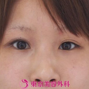 目頭切開 の症例写真 美容整形は東京美容外科